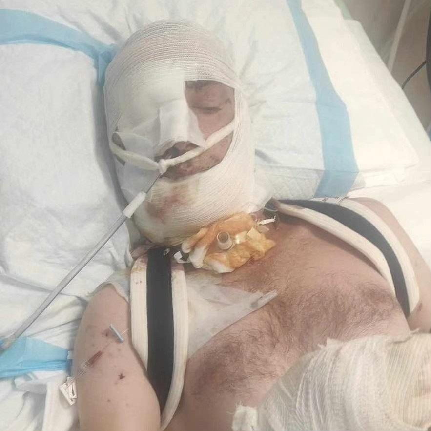 Михайло отримав дуже важкі поранення і нині на нього чекають тривале лікування і реабілітація