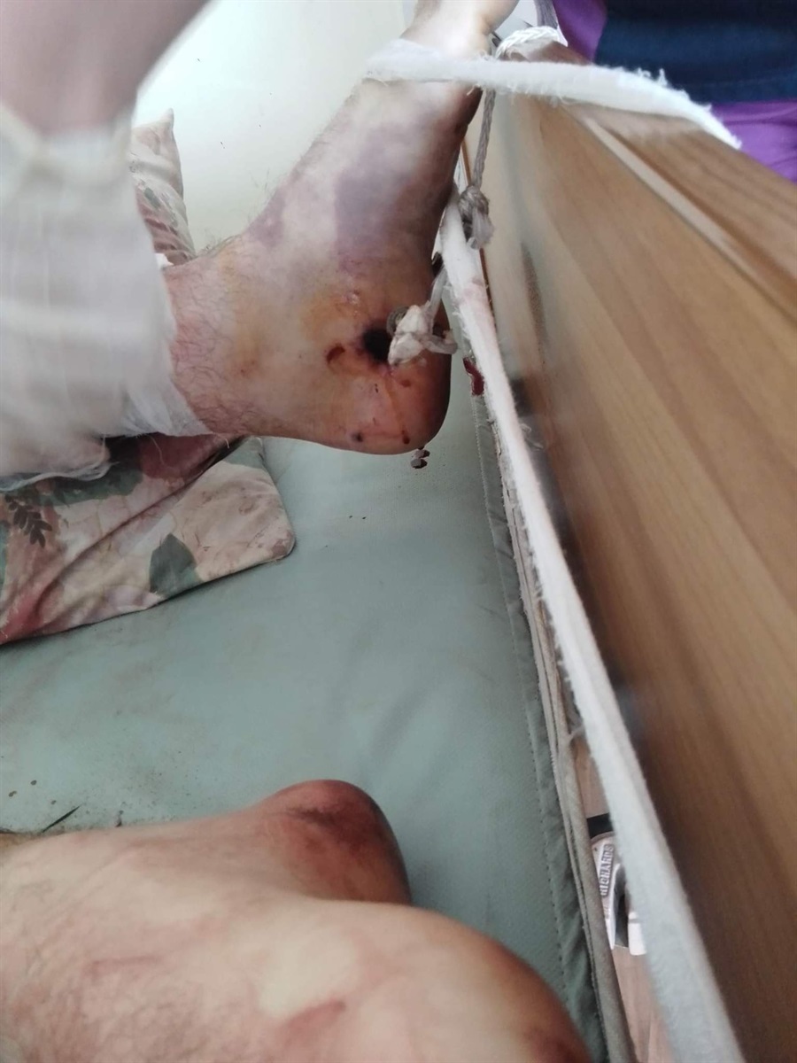 Лікарі намагалися врятувати ногу Владислава 